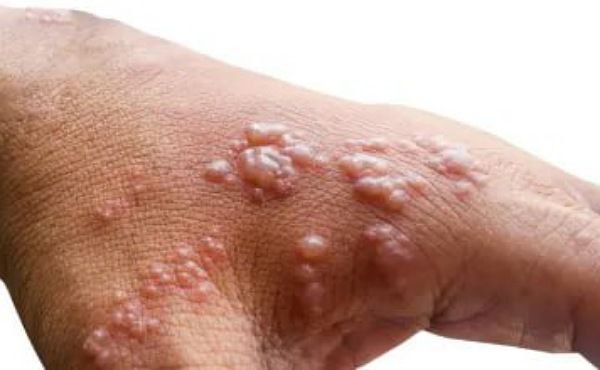Monkeypox in Kuwait?